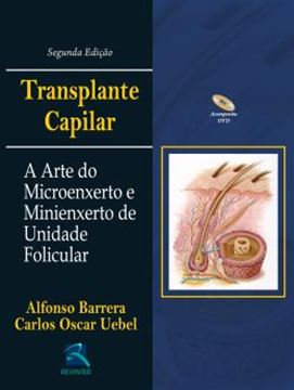 Imagem de TRANSPLANTE CAPILAR - A ARTE DO MICRO E MINIENXERTO DA UNIDADE FOLICULAR